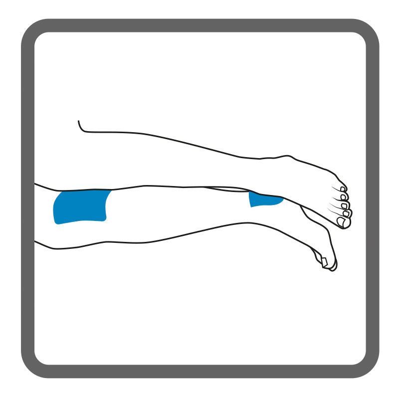 Illustration of lower legs, side lying, with shading to show the placement of a Dermisplus Prevent pad between the knees and between the ankles.